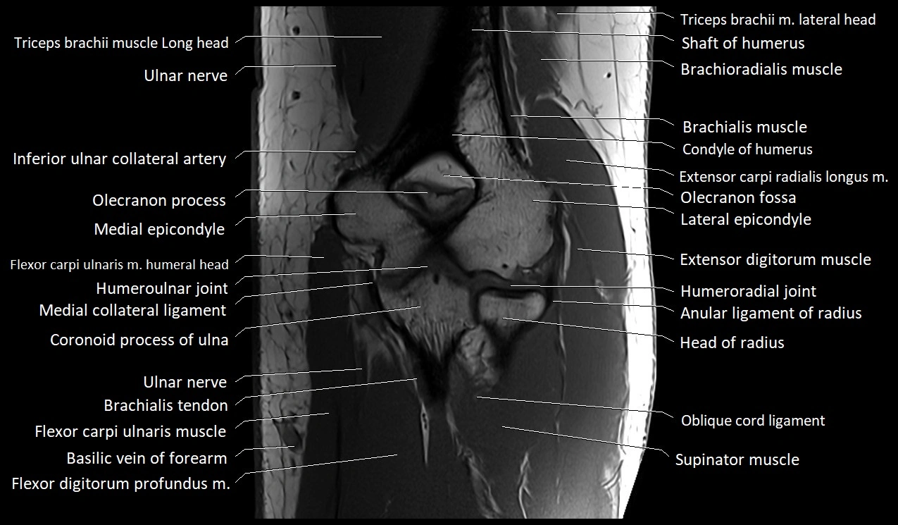 Elbow coronal anatomy image  cross sectional 3T MRI image 22.webp